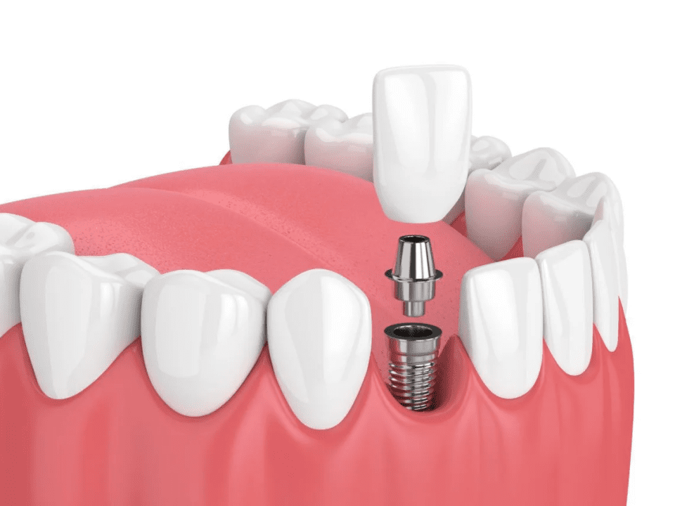 Dental Implants In Wilmington